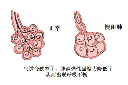 慢阻肺-肺病-慢性-呼吸障礙-咳嗽-咳痰-康復(fù)-肺功能檢測(cè)儀