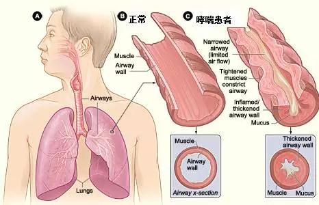 哮喘-呼吸-呼吸肌-肺病-鄧麗君-遺傳-咳嗽-呼吸困難-肺功能檢測儀