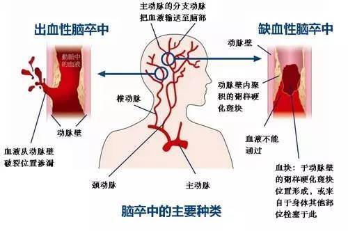 肺炎-呼吸訓練器-基層肺功能-腦卒中-心血管病-中風-腦梗-慢阻肺-哮喘-呼吸肌-排痰-肺功能檢測儀-賽客