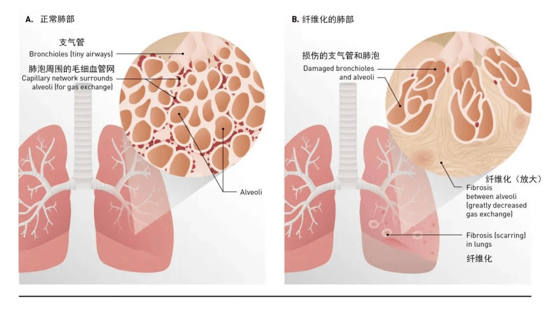 肺纖維化-肺炎-吸煙-特發(fā)性肺纖維化-肺功能-肺功能檢測儀-呼吸訓(xùn)練器-慢阻肺-哮喘-免疫力-咽炎-咳嗽-干咳-呼吸肌